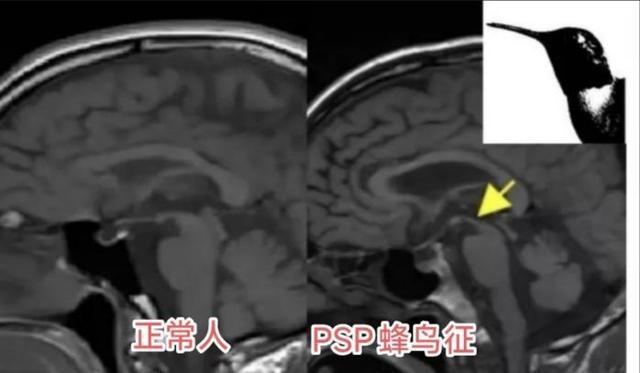 陕西省核工业二一五医院：83岁患者的大脑里医生抓住了一只闯祸的“蜂鸟”！(图4)